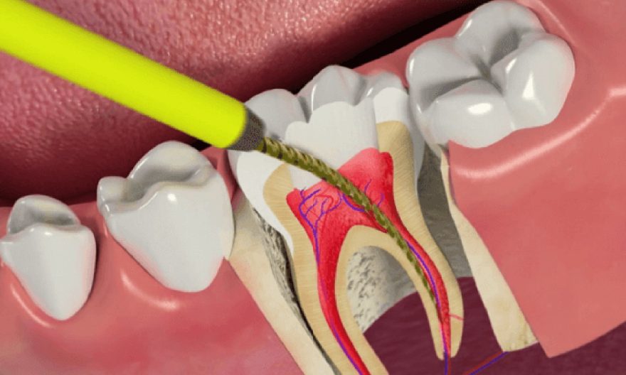 manfaat perawatan saluran akar gigi